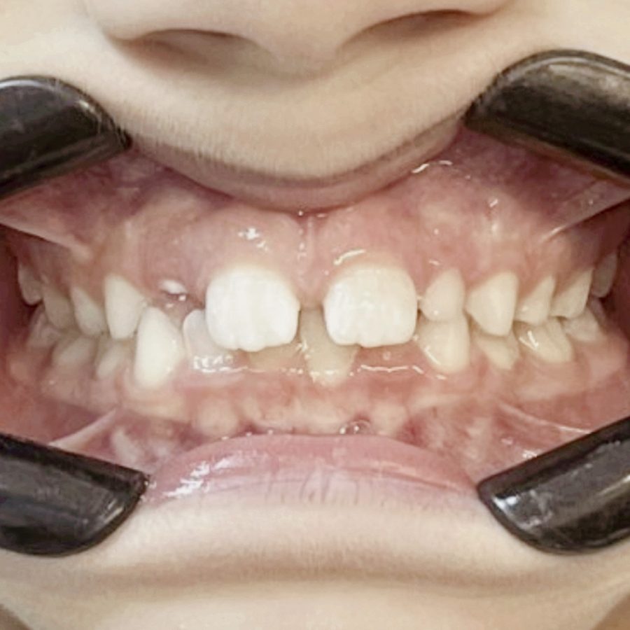 Sorriso antes do tratamento — caso 2