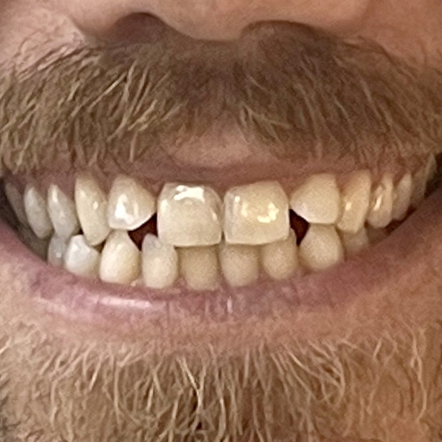 Sorriso antes do tratamento — caso 3