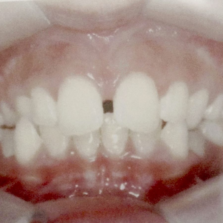 Sorriso antes do tratamento — caso 4