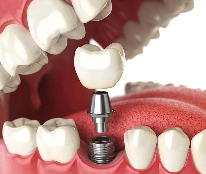 Ilustração de implante dentário: pino, pilar e coroa posicionados no osso