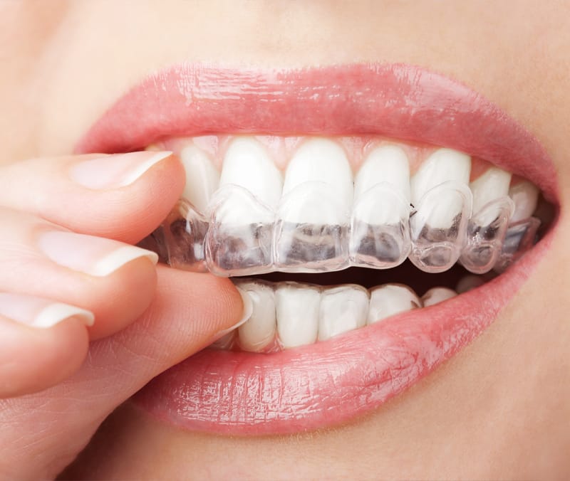 Alinhador transparente sendo encaixado sobre os dentes superiores
